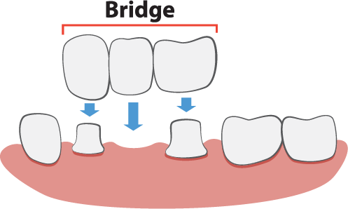 Dental Bridges illustration in Worcester Ma